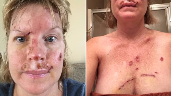 Judy Cloud, 49, shows the scars of her skin cancer from too much sunbathing