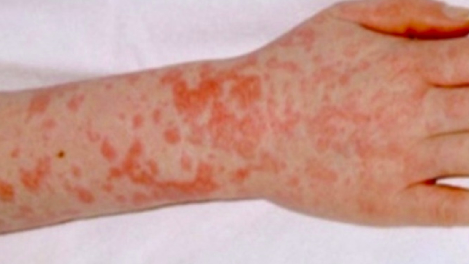 scarlet fever symptoms