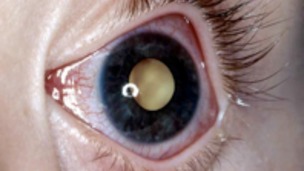 An illustration of what Retinoblastoma can look like in the eye